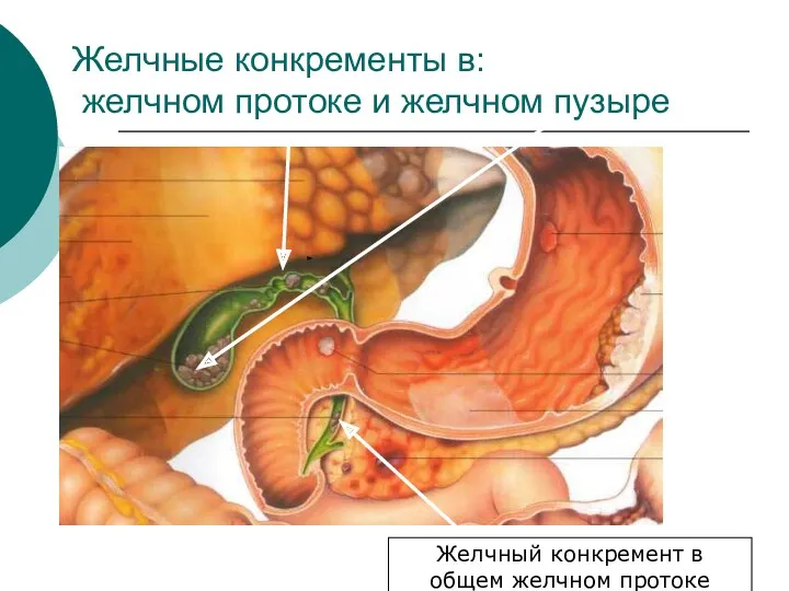 Желчные конкременты в: желчном протоке и желчном пузыре Желчный конкремент в общем желчном протоке