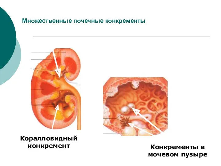 Множественные почечные конкременты Коралловидный конкремент Конкременты в мочевом пузыре