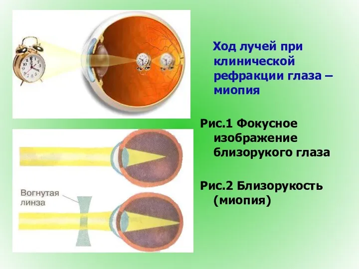 Ход лучей при клинической рефракции глаза – миопия Рис.1 Фокусное изображение близорукого глаза Рис.2 Близорукость (миопия)