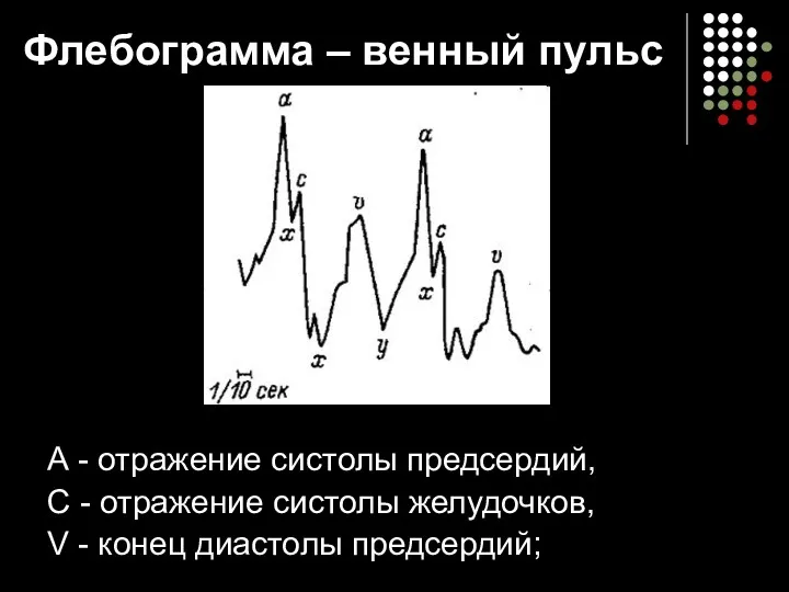 Флебограмма – венный пульс А - отражение систолы предсердий, С