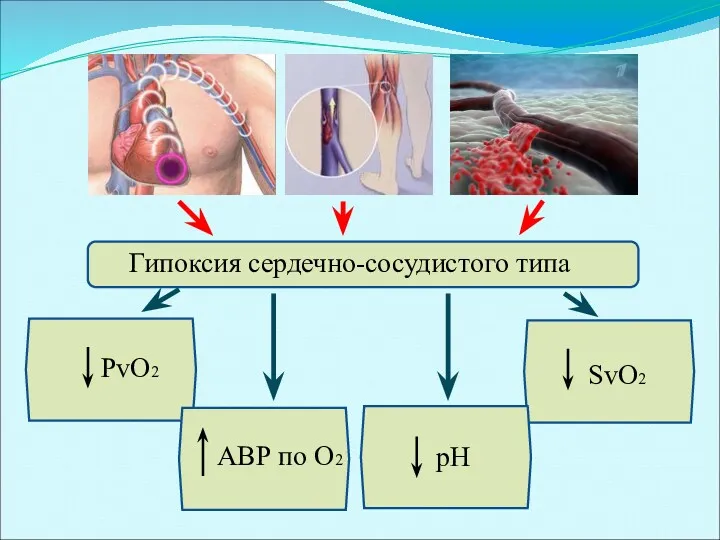 Гипоксия сердечно-сосудистого типа PvO2 pH SvO2 АВР по O2