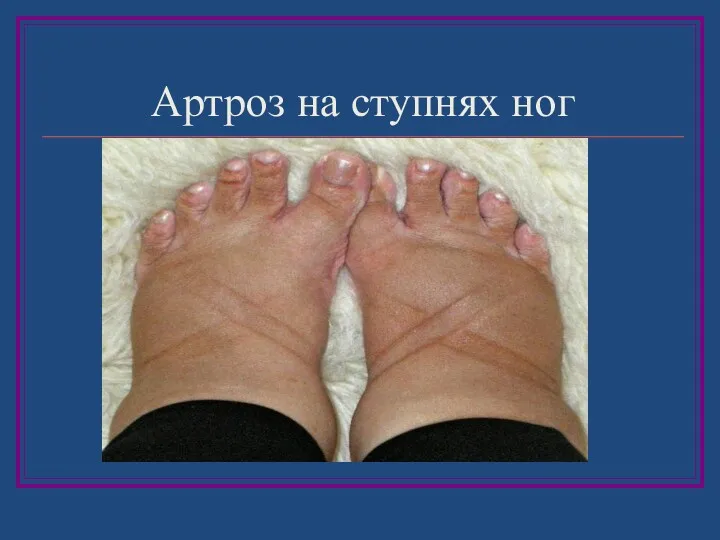 Артроз на ступнях ног