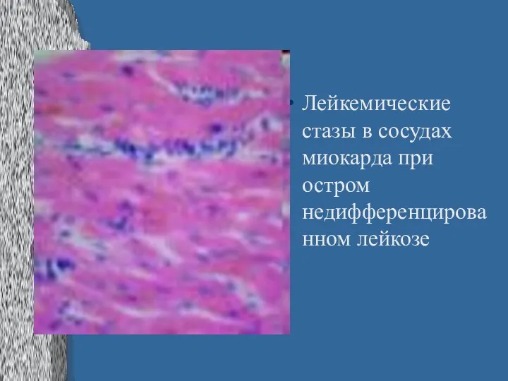 Лейкемические стазы в сосудах миокарда при остром недифференцированном лейкозе