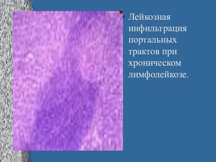 Лейкозная инфильтрация портальных трактов при хроническом лимфолейкозе.