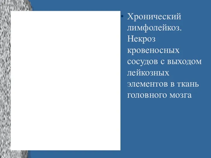 Хронический лимфолейкоз. Некроз кровеносных сосудов с выходом лейкозных элементов в ткань головного мозга