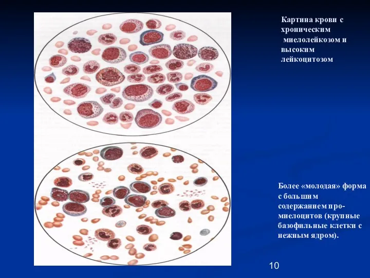 Картина крови с хроническим миелолейкозом и высоким лейкоцитозом Более «молодая»