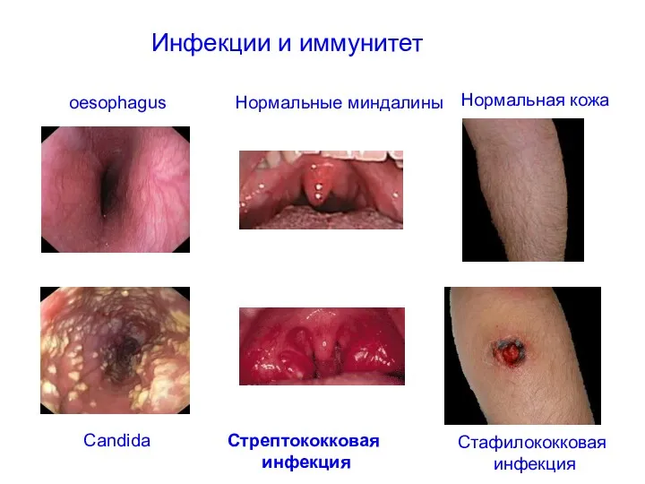 Инфекции и иммунитет oesophagus Нормальные миндалины Нормальная кожа Candida Стрептококковая инфекция Стафилококковая инфекция