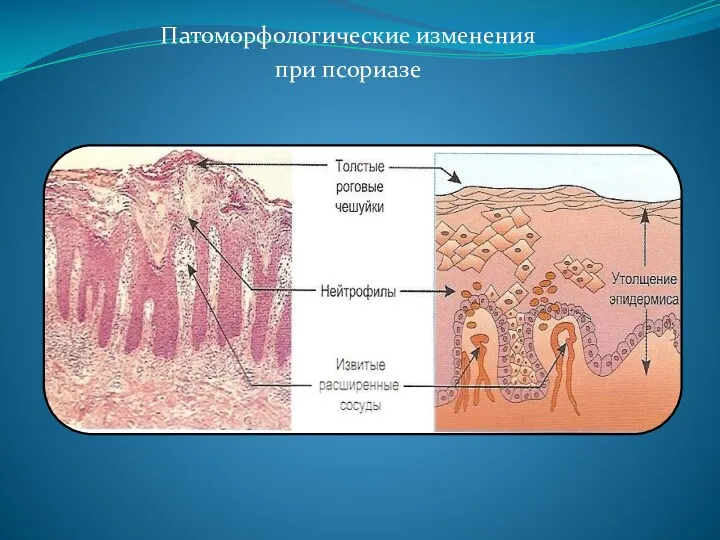 Патоморфологические изменения при псориазе