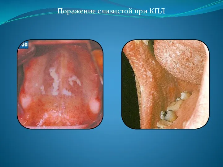 Поражение слизистой при КПЛ