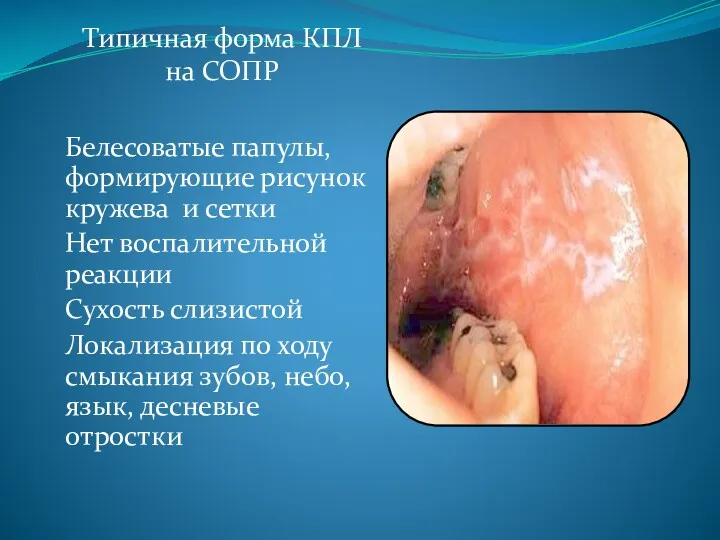 Типичная форма КПЛ на СОПР Белесоватые папулы, формирующие рисунок кружева