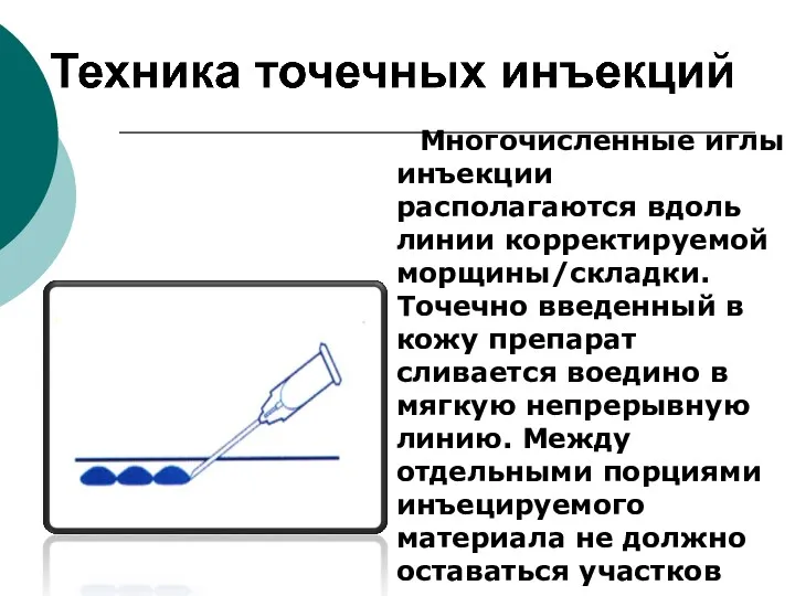 Многочисленные иглы инъекции располагаются вдоль линии корректируемой морщины/складки. Точечно введенный