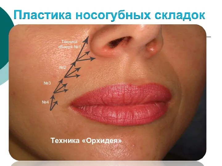 Силовые линии напряжения морщин Техника «Веер» №1 №2 №3 №4 Техника «Орхидея»