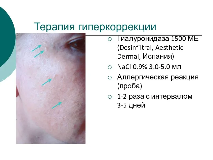 Терапия гиперкоррекции Гиалуронидаза 1500 МЕ (Desinfiltral, Aesthetic Dermal, Испания) NaCl