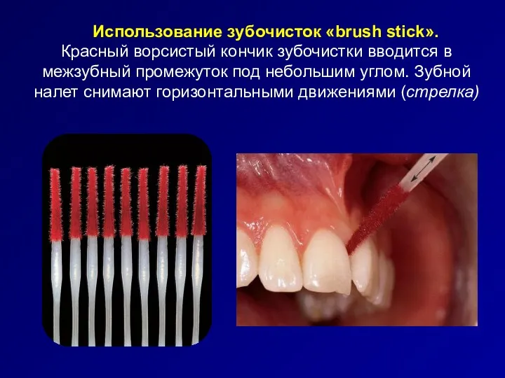 Использование зубочисток «brush stick». Красный ворсистый кончик зубочистки вводится в