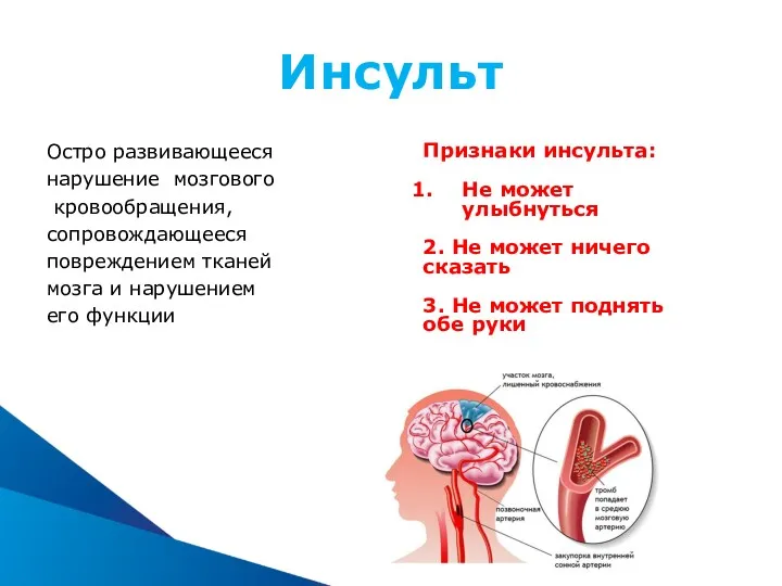 Инсульт Остро развивающееся нарушение мозгового кровообращения, сопровождающееся повреждением тканей мозга