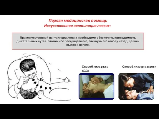 Искусственная вентиляция легких: Первая медицинская помощь При искусственной вентиляции легких