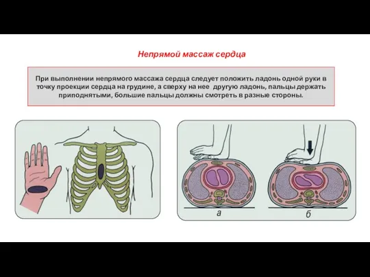 Непрямой массаж сердца При выполнении непрямого массажа сердца следует положить