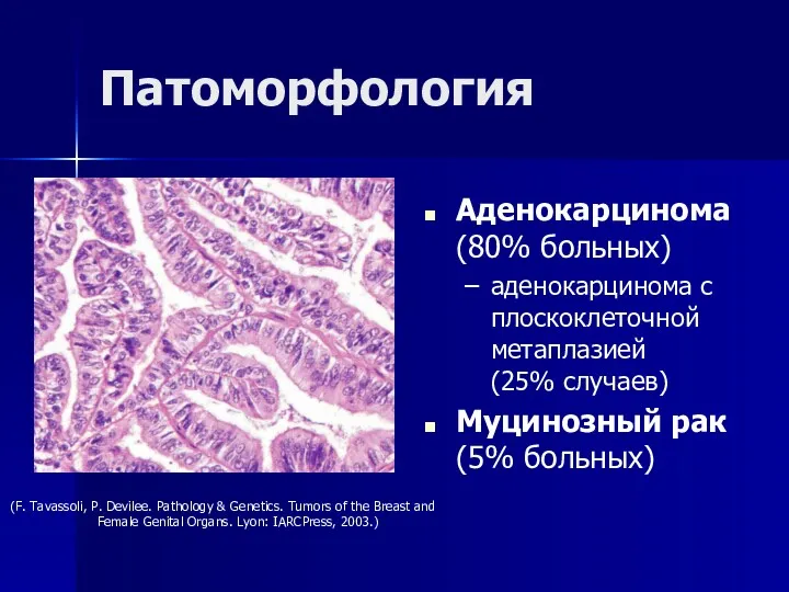 Патоморфология Аденокарцинома (80% больных) аденокарцинома с плоскоклеточной метаплазией (25% случаев)