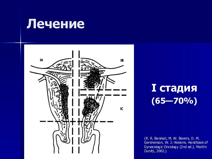 Лечение I стадия (65—70%) (R. R. Barakat, M. W. Bevers,