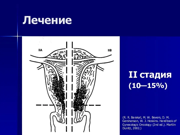 Лечение II стадия (10—15%) (R. R. Barakat, M. W. Bevers,