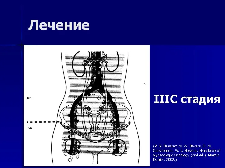 Лечение IIIC стадия (R. R. Barakat, M. W. Bevers, D.