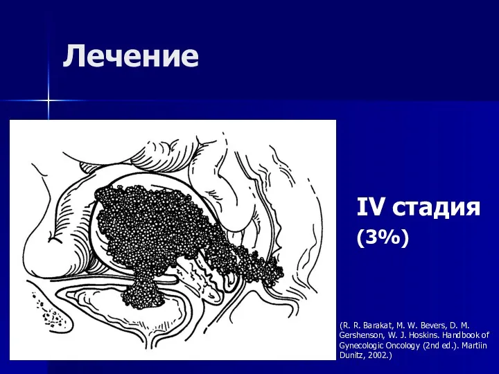 Лечение IV стадия (3%) (R. R. Barakat, M. W. Bevers,