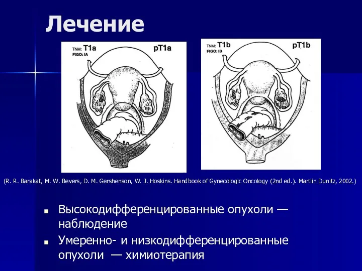 Лечение Высокодифференцированные опухоли — наблюдение Умеренно- и низкодифференцированные опухоли —