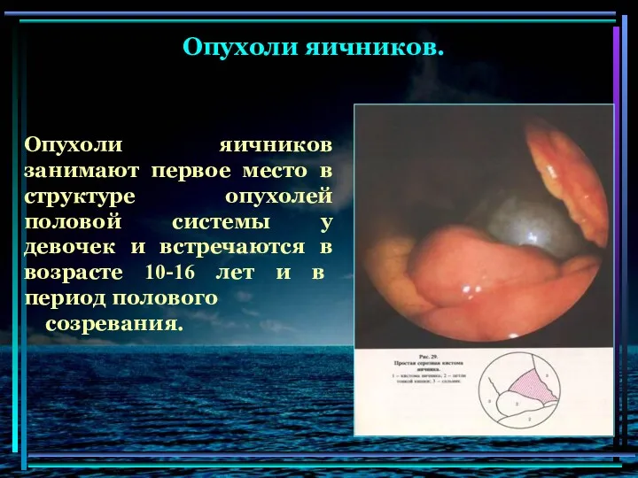 Опухоли яичников занимают первое место в структуре опухолей половой системы