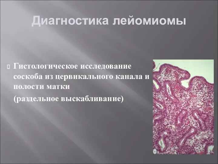 Диагностика лейомиомы Гистологическое исследование соскоба из цервикального канала и полости матки (раздельное выскабливание)