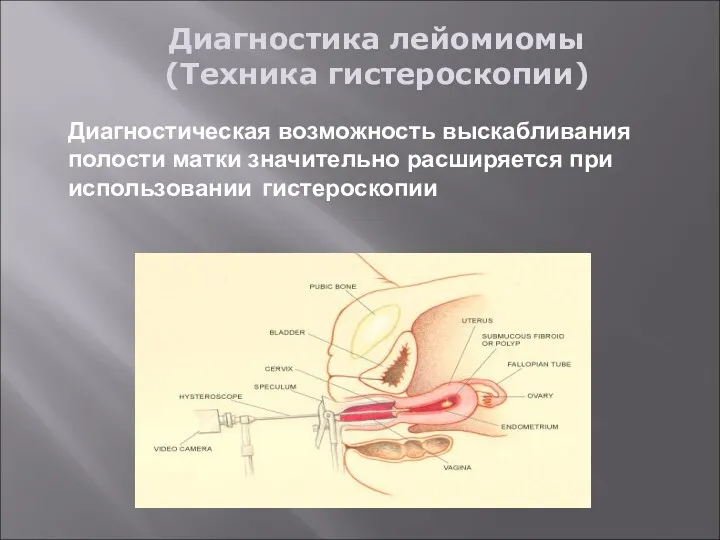 Диагностика лейомиомы (Техника гистероскопии) Диагностическая возможность выскабливания полости матки значительно расширяется при использовании гистероскопии