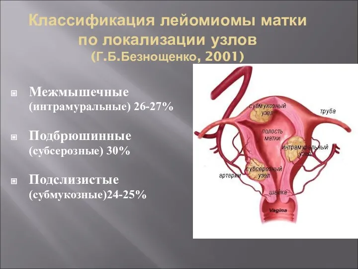 Классификация лейомиомы матки по локализации узлов (Г.Б.Безнощенко, 2001) Межмышечные (интрамуральные) 26-27% Подбрюшинные (субсерозные) 30% Подслизистые (субмукозные)24-25%
