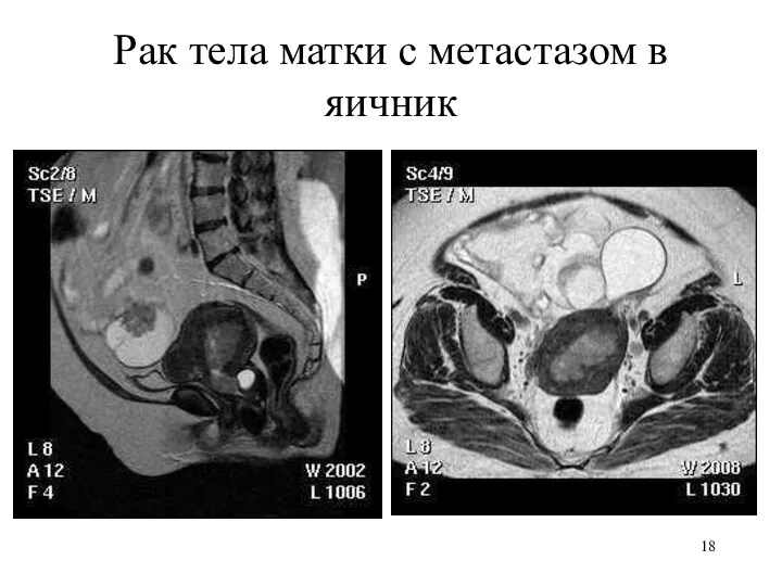 Рак тела матки с метастазом в яичник