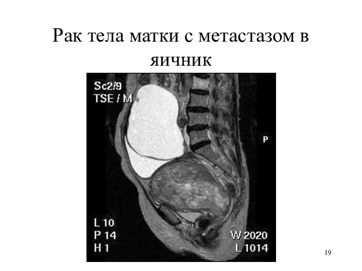 Рак тела матки с метастазом в яичник