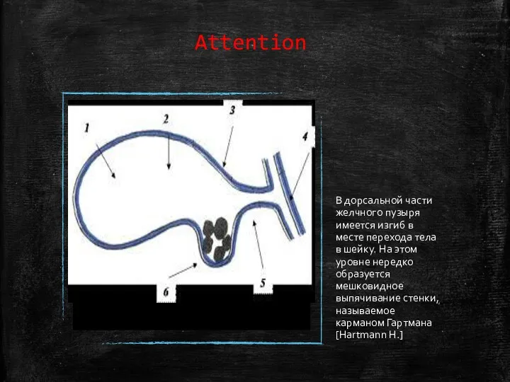 Attention В дорсальной части желчного пузыря имеется изгиб в месте