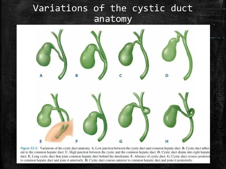 Variations of the cystic duct anatomy