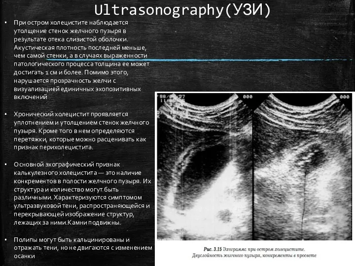 Ultrasonography(УЗИ) При остром холецистите наблюдается утолщение стенок желчного пузыря в