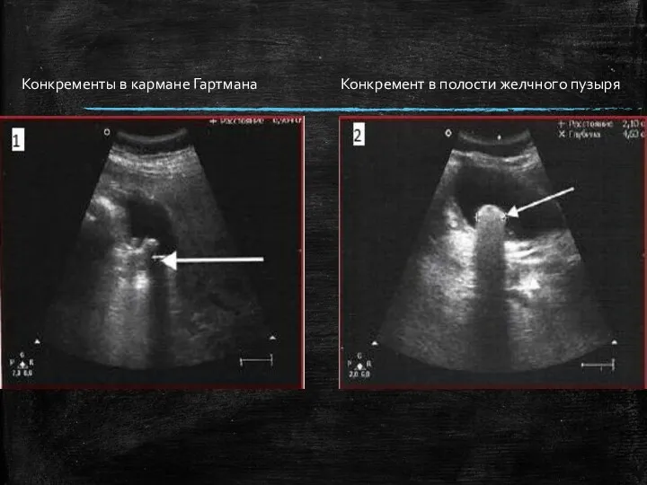 Конкременты в кармане Гартмана Конкремент в полости желчного пузыря