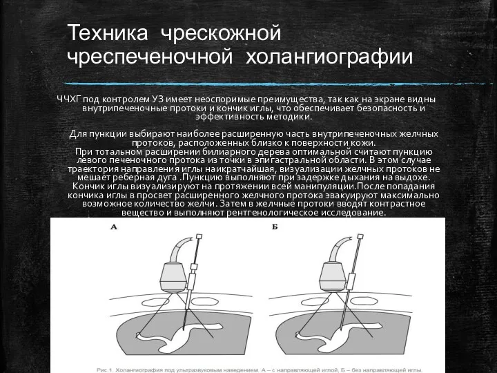 Техника чрескожной чреспеченочной холангиографии ЧЧХГ под контролем УЗ имеет неоспоримые