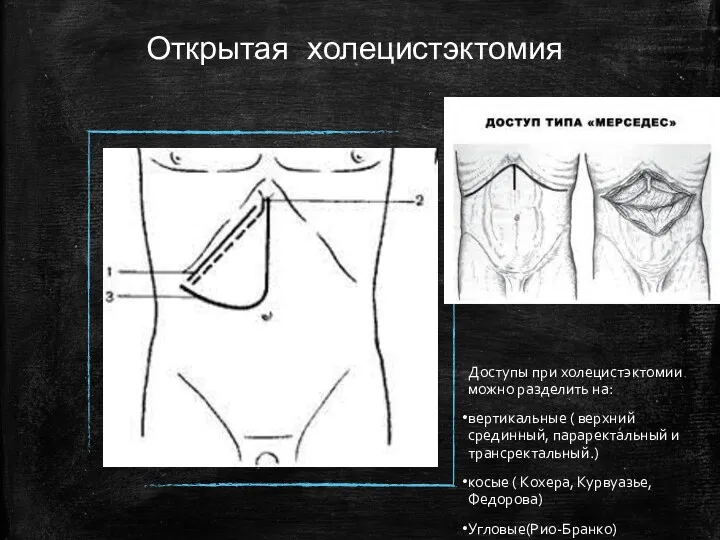 Открытая холецистэктомия Доступы при холецистэктомии можно разделить на: вертикальные (