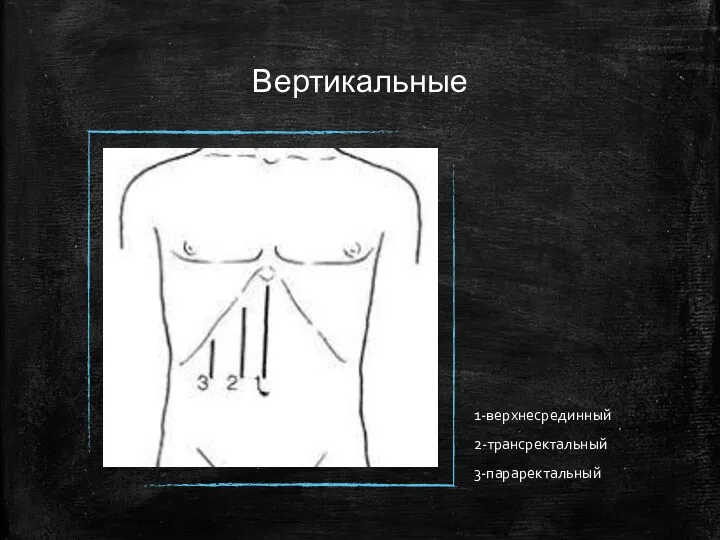 Вертикальные 1-верхнесрединный 2-трансректальный 3-параректальный