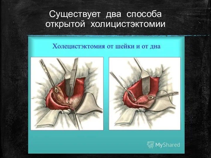 Существует два способа открытой холицистэктомии От шейки От дна