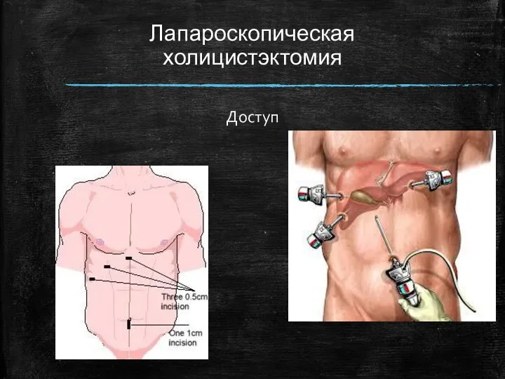 Лапароскопическая холицистэктомия Доступ