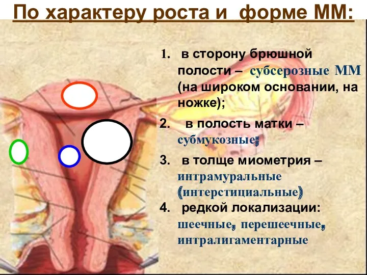 в сторону брюшной полости – субсерозные ММ (на широком основании, на ножке); в