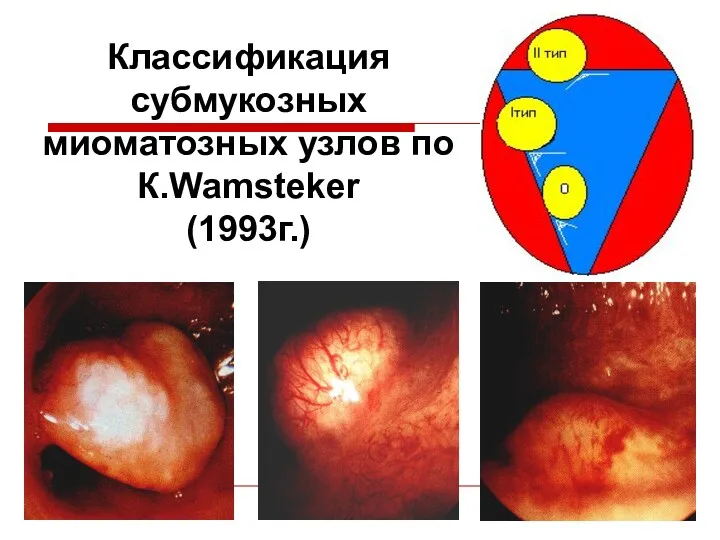 Классификация субмукозных миоматозных узлов по К.Wamsteker (1993г.)