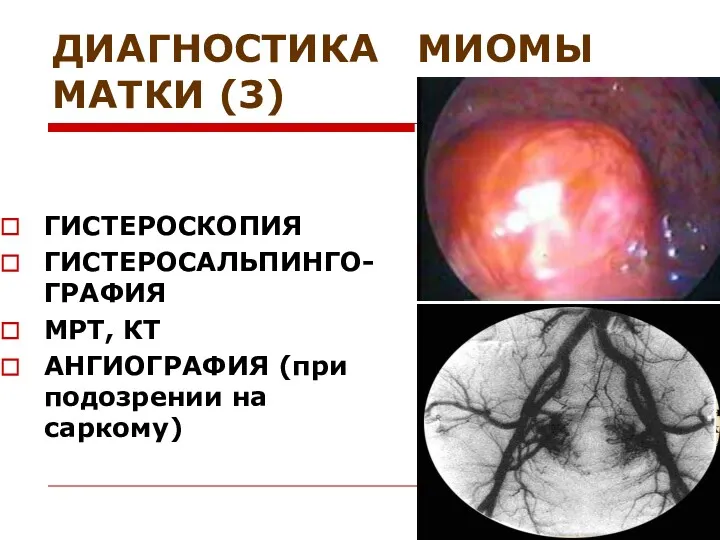 ДИАГНОСТИКА МИОМЫ МАТКИ (3) ГИСТЕРОСКОПИЯ ГИСТЕРОСАЛЬПИНГО-ГРАФИЯ МРТ, КТ АНГИОГРАФИЯ (при подозрении на саркому)