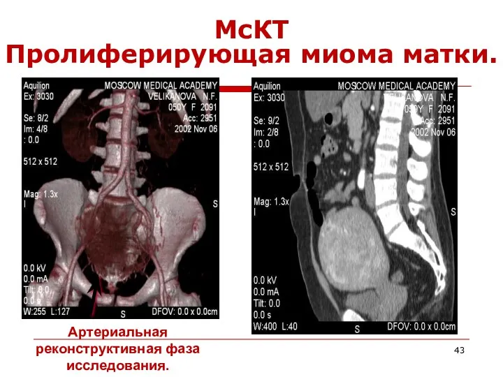 МсКТ Пролиферирующая миома матки. Артериальная реконструктивная фаза исследования.