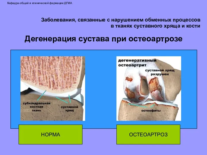 Дегенерация сустава при остеоартрозе НОРМА ОСТЕОАРТРОЗ Заболевания, связанные с нарушением