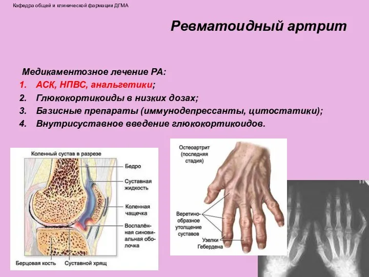 Ревматоидный артрит Медикаментозное лечение РА: АСК, НПВС, анальгетики; Глюкокортикоиды в