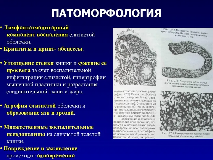 ПАТОМОРФОЛОГИЯ Лимфоплазмоцитарный компонент воспаления слизистой оболочки. Криптиты и крипт- абсцессы.