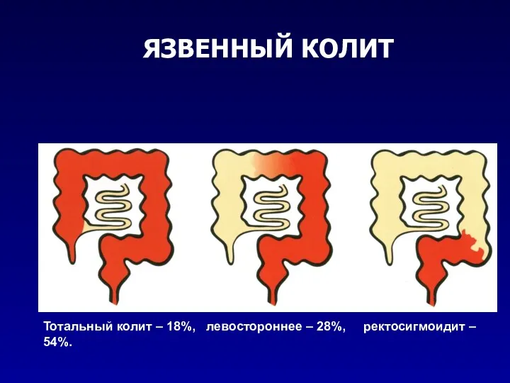 ЯЗВЕННЫЙ КОЛИТ Тотальный колит – 18%, левостороннее – 28%, ректосигмоидит – 54%.